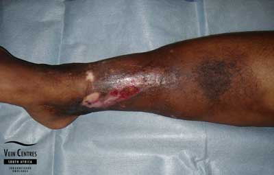 Venous Ulcer after treatment