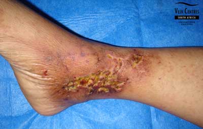 Venous Ulcer