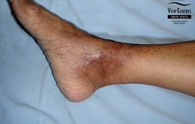 Venous Ulcer after treatment