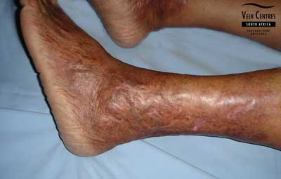 Venous ulcer after treatment