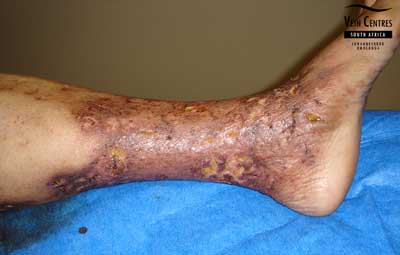 Venous Ulcer