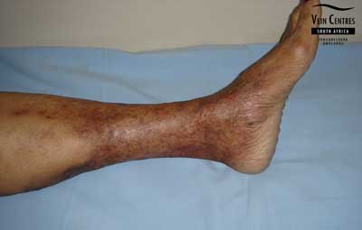 Venous Ulcer after treatment