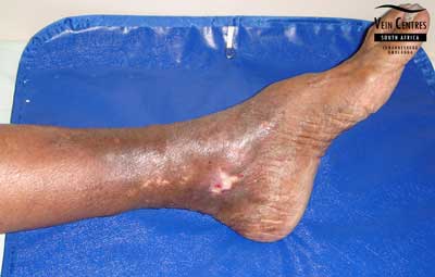 Venous ulcer