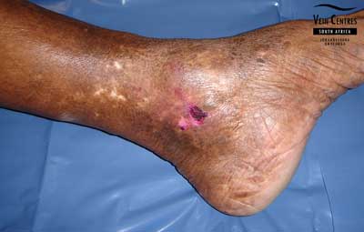 Venous ulcer after treatment