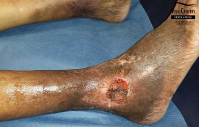 Venous Ulcer