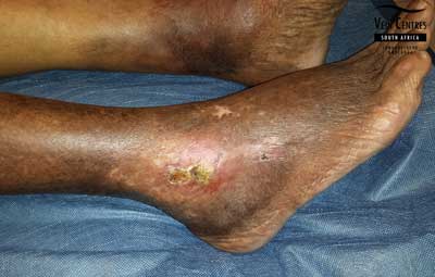 Venous ulcer after treatment