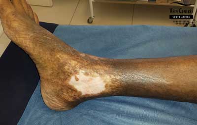 Venous ulcer after treatment