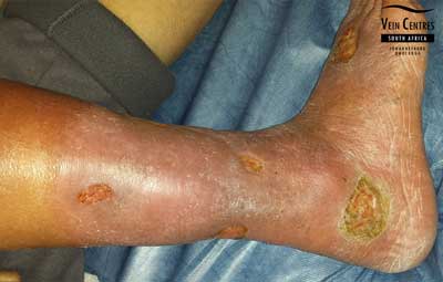 Venous ulcer