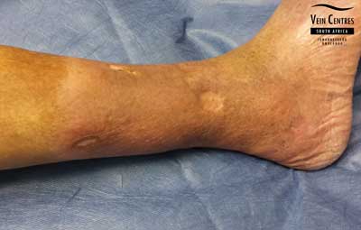 Venous ulcer after treatment