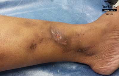 Venous ulcer after treatment