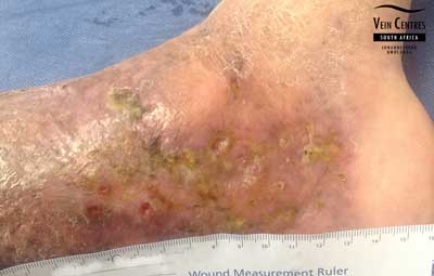 Venous ulcer