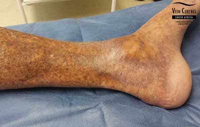 Venous Ulcer after treatment