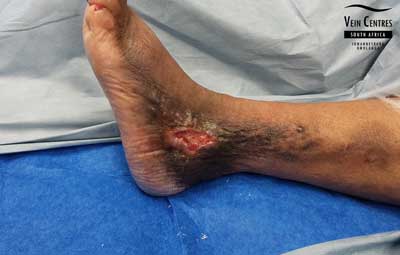 Venous Ulcer