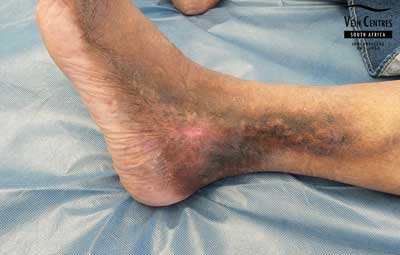 Venous ulcer after treatment