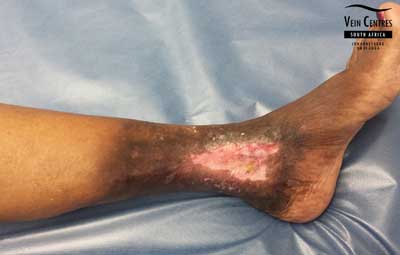 Venous ulcer after treatment