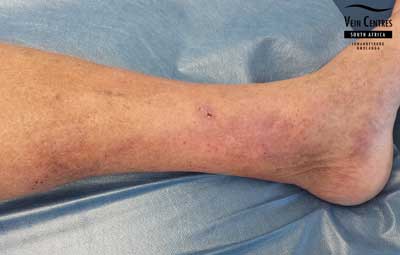 Venous ulcer after treatment