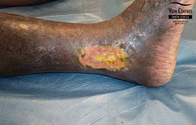 Venous ulcer