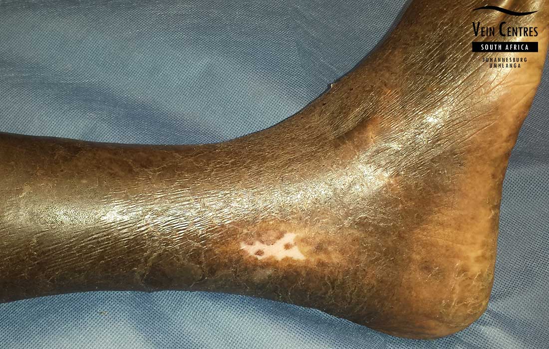 Venous ulcer after treatment