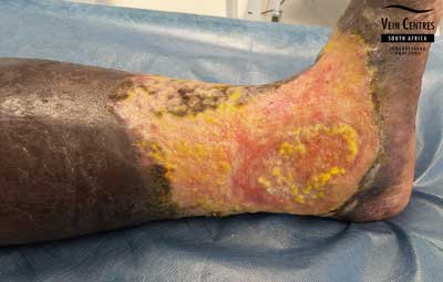 venous ulcer