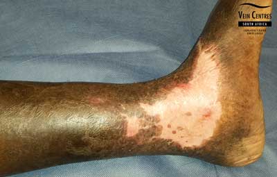 Venous Ulcer after treatment