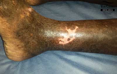 Venous Ulcer after treatment