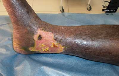 Venous Ulcer