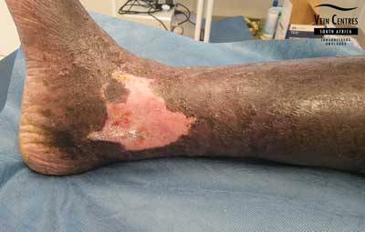 Venous ulcer after treatment