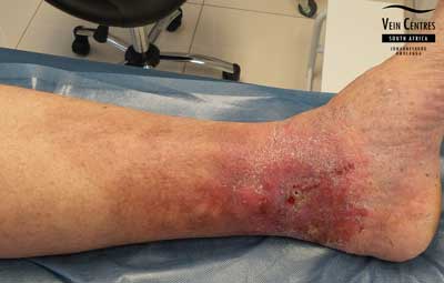 Venous Ulcer