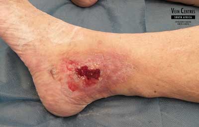 Venous Ulcer