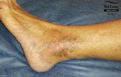 Venous Ulcer after treatment