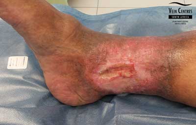 Venous ulcer