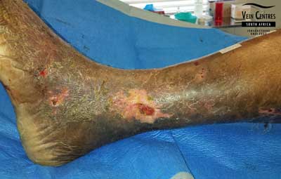 Venous Ulcer