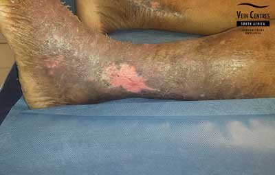 Venous Ulcer after treatment