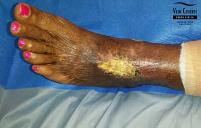 Venous ulcer