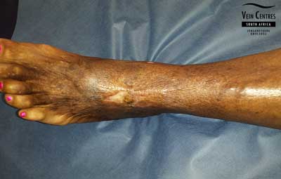 Venous Ulcer after treatment