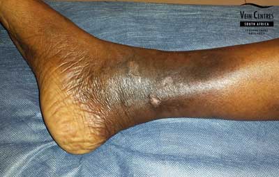 Venous ulcer after treatment