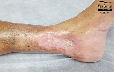 Venous Ulcer after treatment