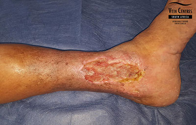 Venous Ulcer